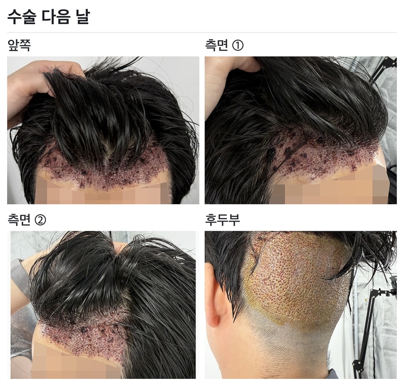 03_수술다음날.jpg