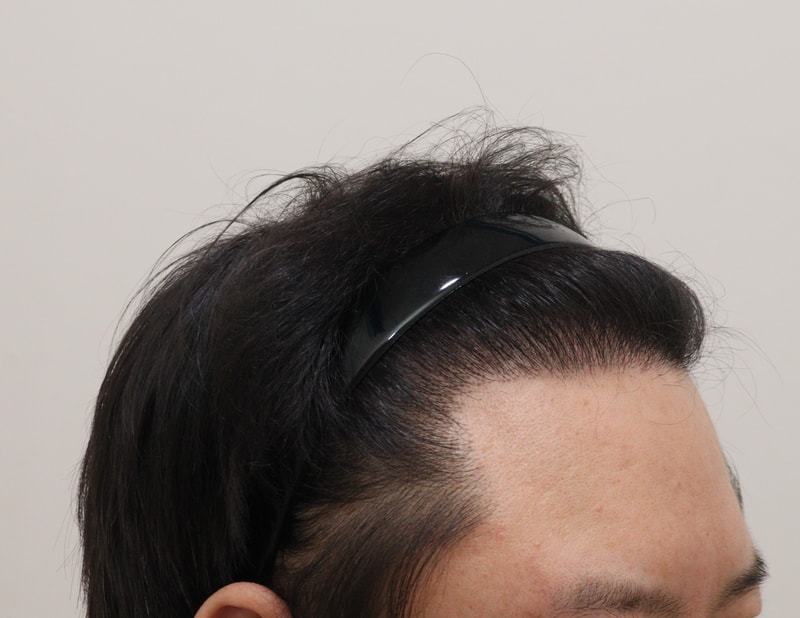 5. 수술후_1년_4.JPG