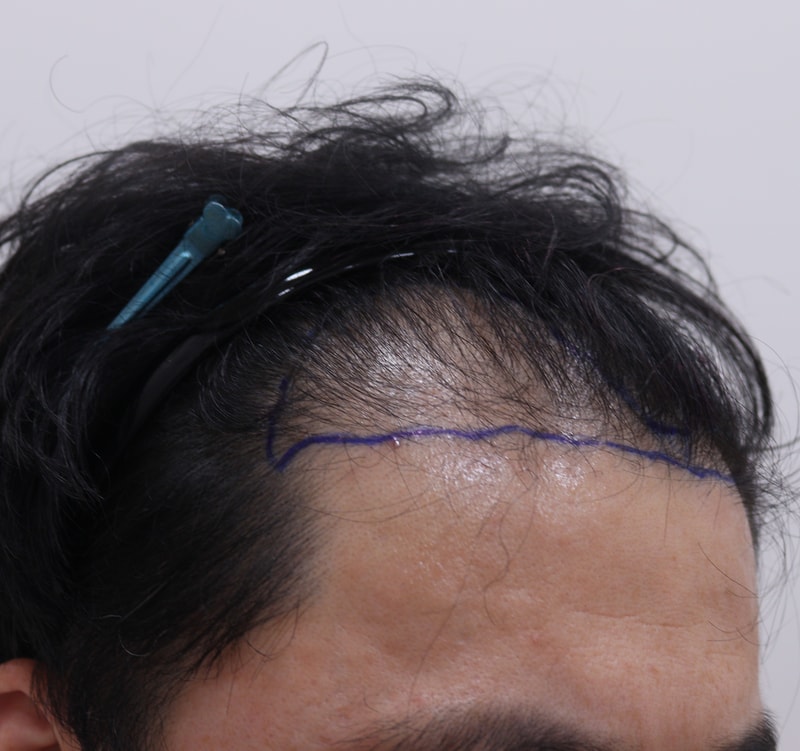 1. 수술전_3.JPG