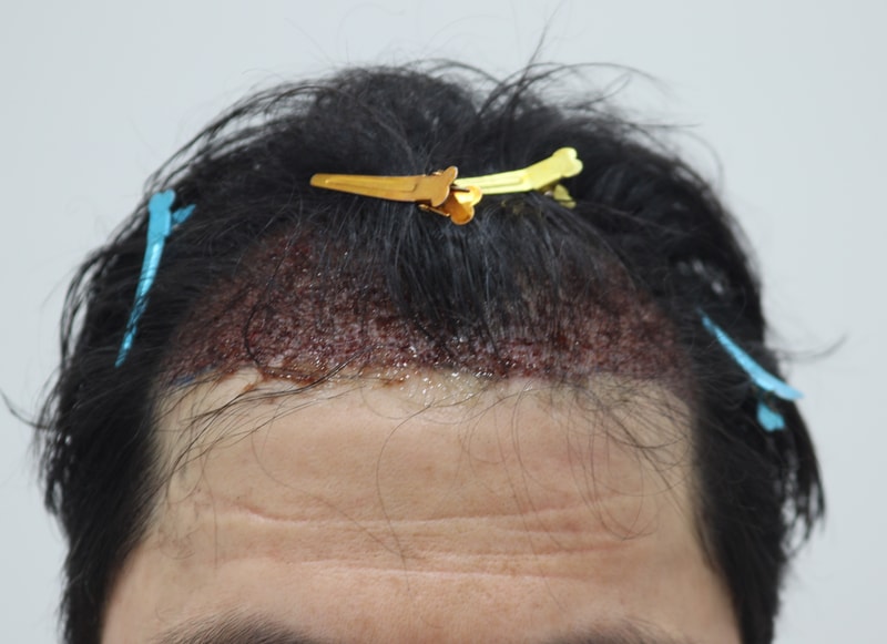 2. 수술후_1일_1.JPG