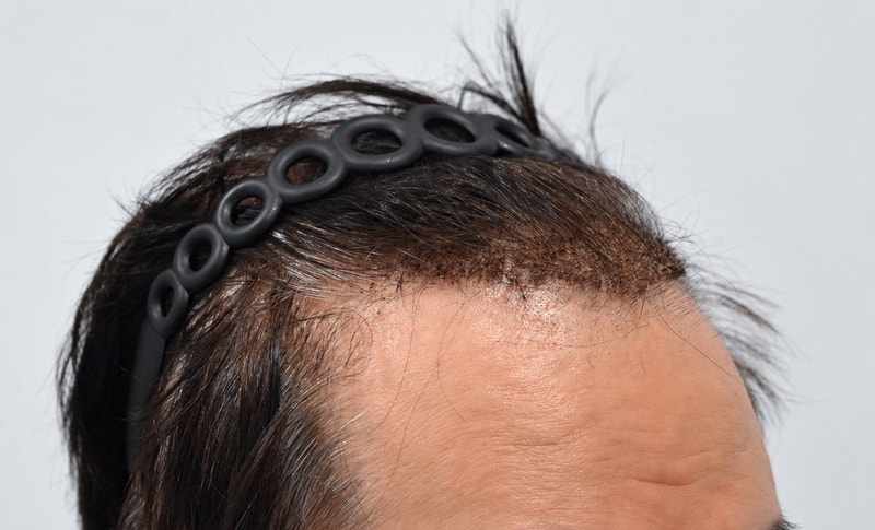hairline_crop_3.jpg