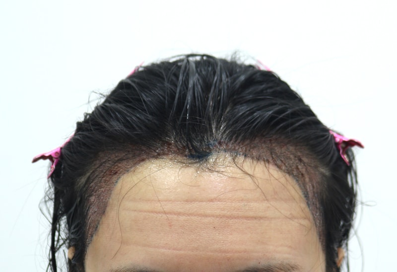 2. 수술후_1일_1.JPG