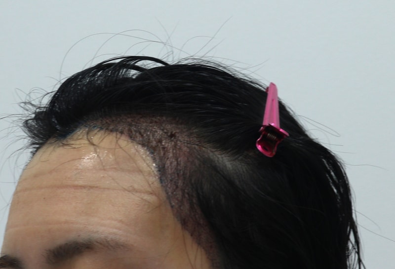 2. 수술후_1일_2.JPG