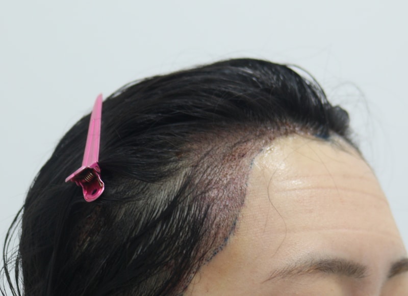 2. 수술후_1일_3.JPG