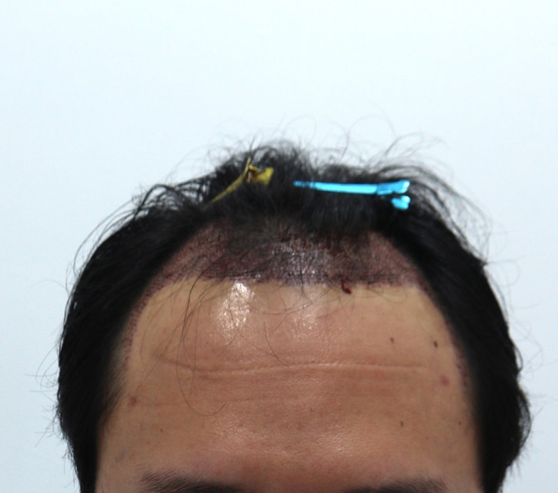 2. 수술후_1일_1.JPG