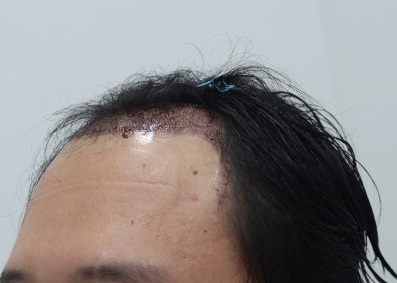 2. 수술후_1일_2.JPG