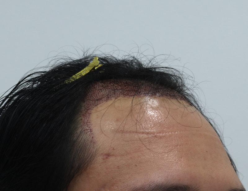 2. 수술후_1일_3.JPG