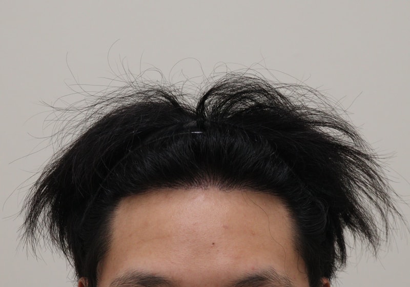 4. 수술후_1년_1.JPG