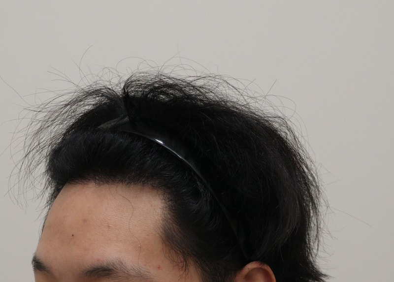 4. 수술후_1년_2.JPG