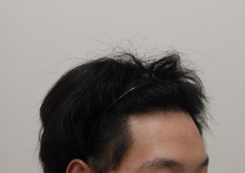 4. 수술후_1년_3.JPG