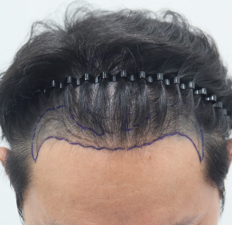 1. 수술전_2.JPG