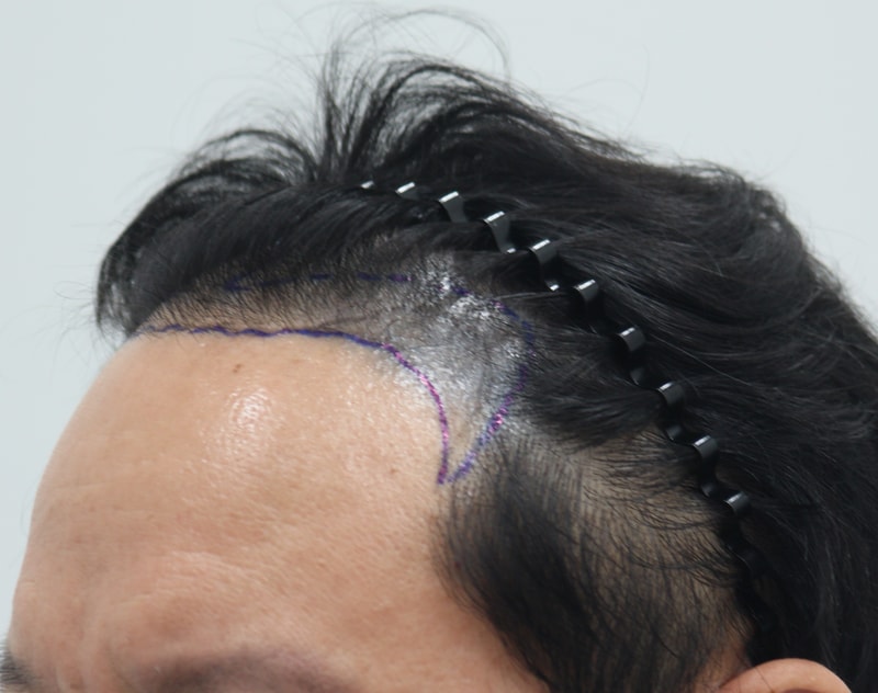 1. 수술전_3.JPG