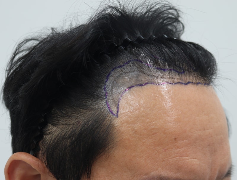 1. 수술전_4.JPG