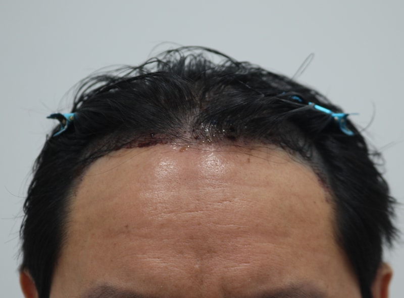 3. 수술후_1일_1.JPG