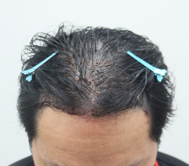 3. 수술후_1일_2.JPG