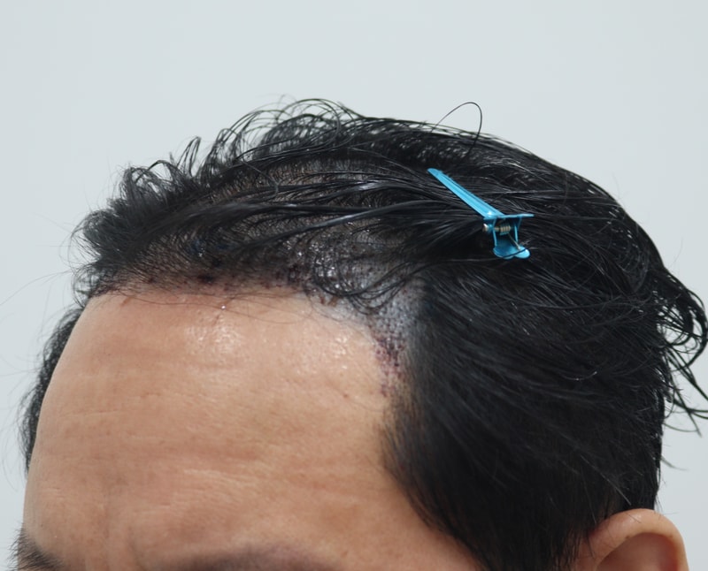 3. 수술후_1일_3.JPG