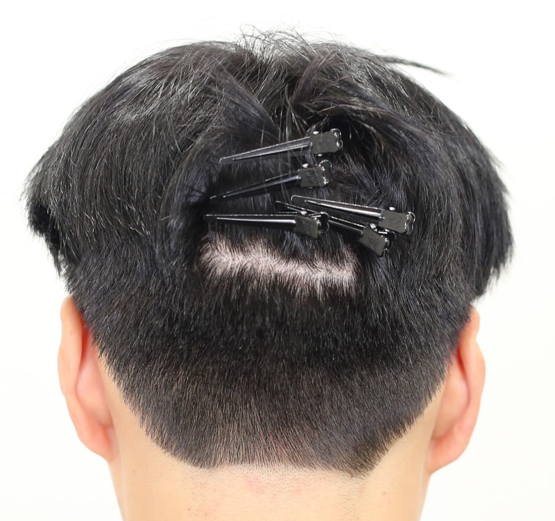 7개월경과 (후).jpg