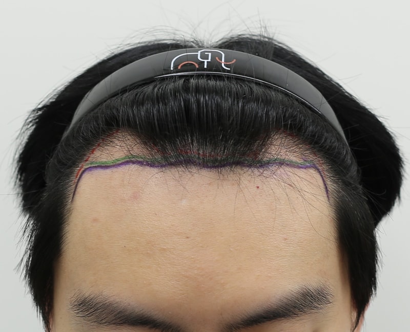 수술전.jpg