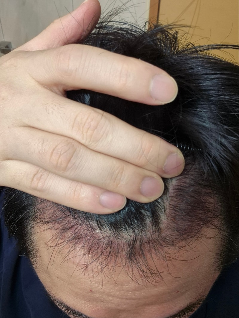 3. 수술후_3개월_1.jpg