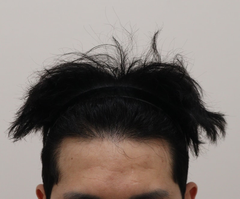 4. 수술후_1년_1.JPG