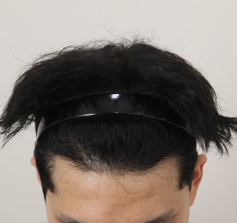 4. 수술후_1년_2.JPG