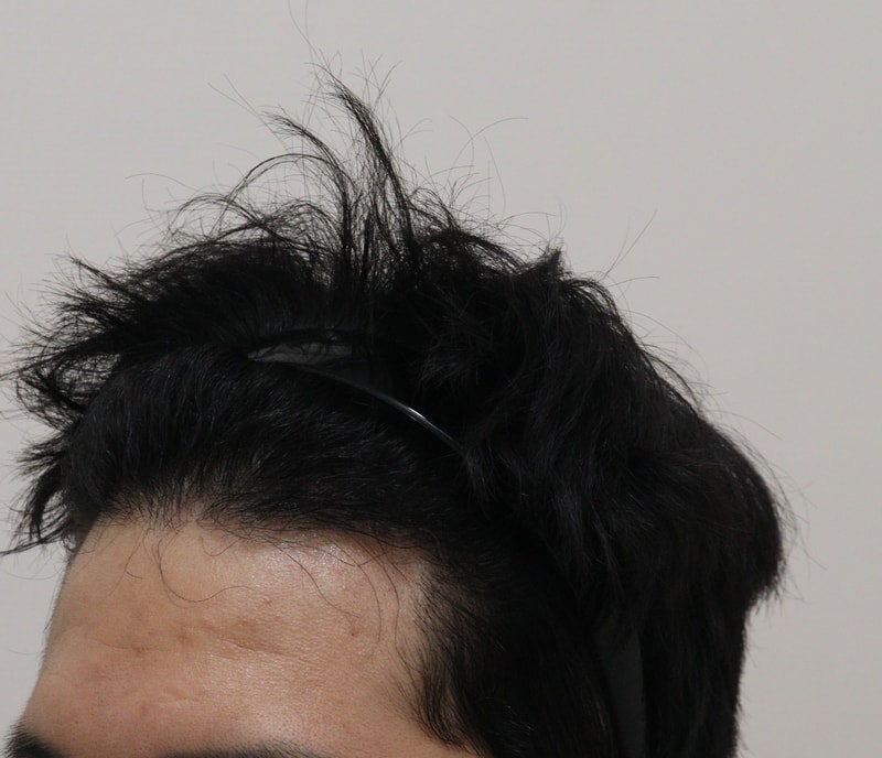 4. 수술후_1년_3.JPG