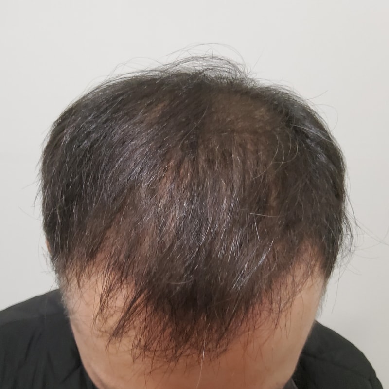 3. 수술후_3개월.jpg