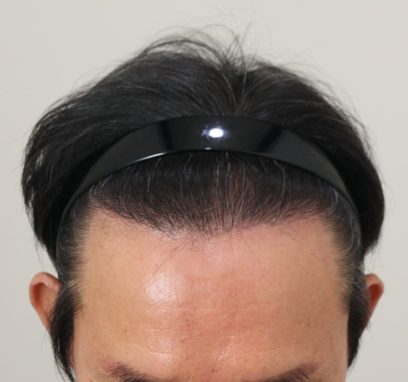 4. 수술후_1년_1.JPG