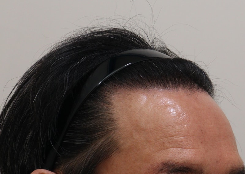 4. 수술후_1년_4.JPG