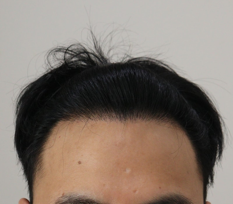 4. 수술후_1년_1.JPG