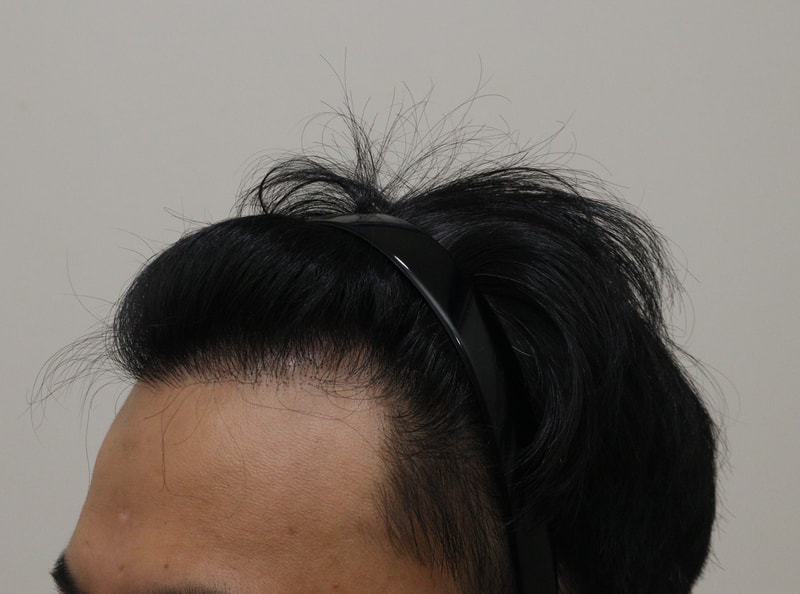 4. 수술후_1년_2.JPG