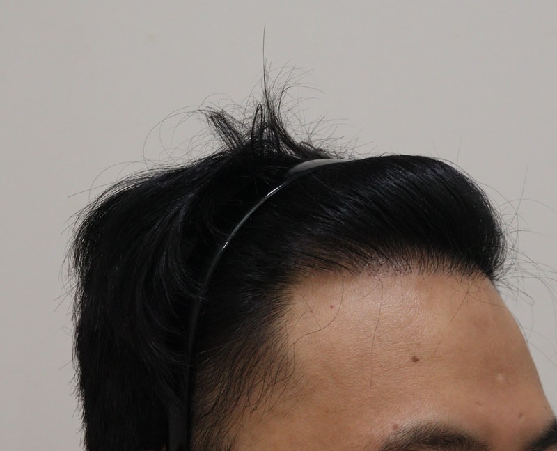 4. 수술후_1년_3.JPG