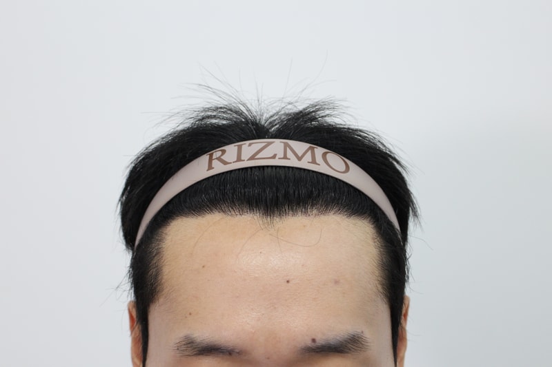 8개월경과1.jpg