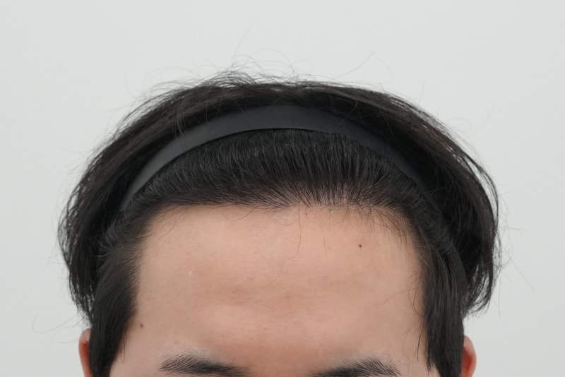 수술3년경과.jpg