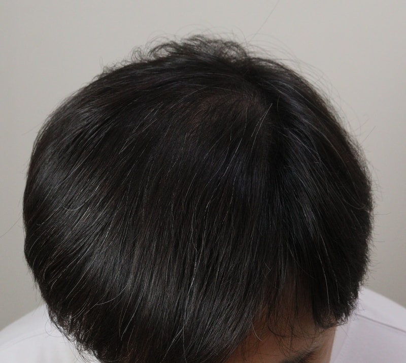3. 수술후_1년_1.JPG