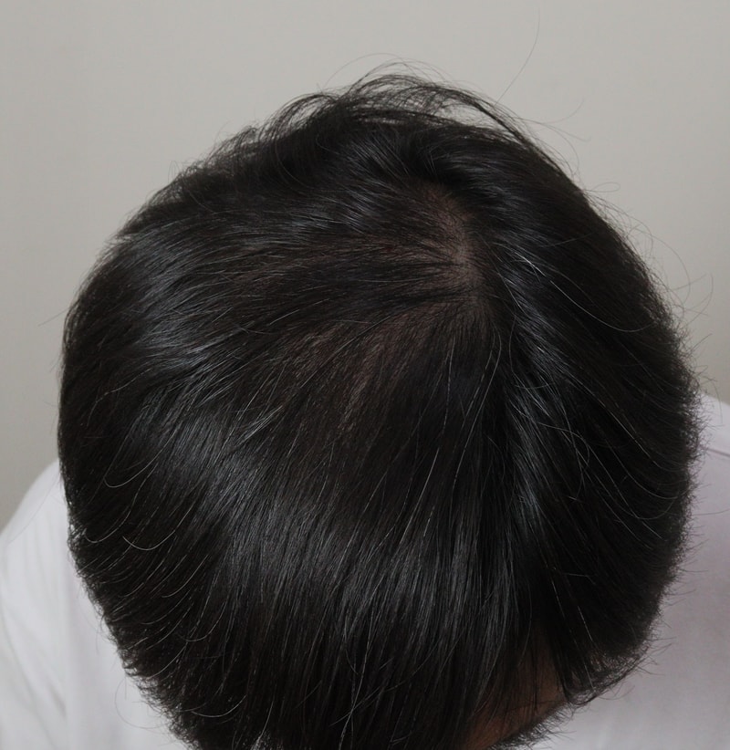 3. 수술후_1년_2.JPG