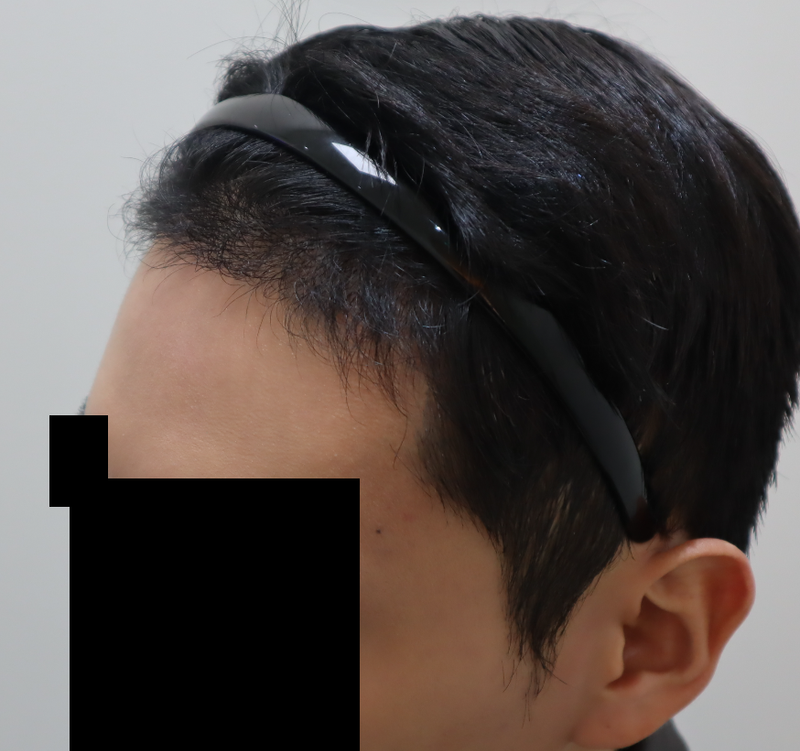 수술 3개월차.png