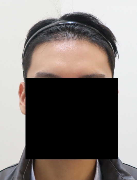 수술 3개월차2.png