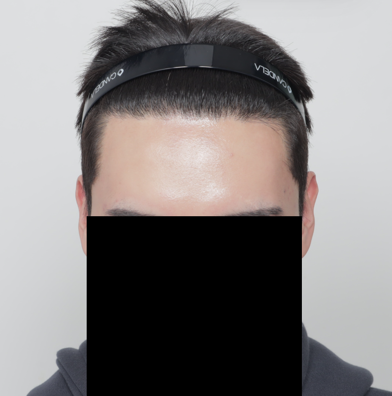 수술 9개월차.png