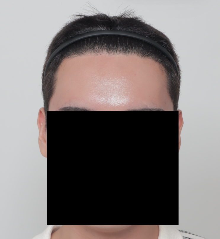 수술 1년차.png