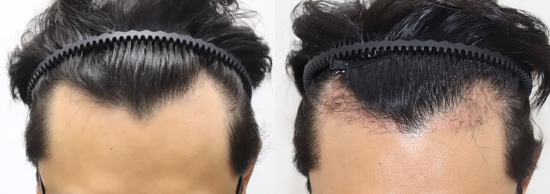 수술전후.jpg