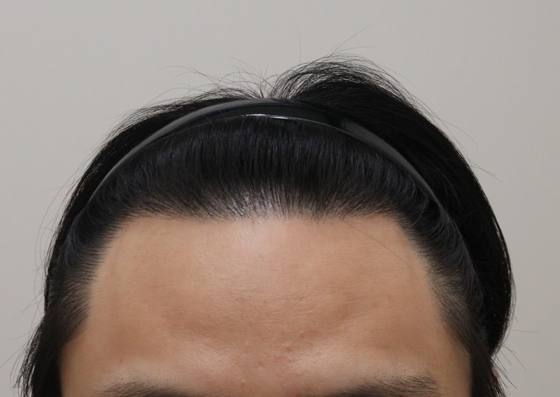 4. 수술후_1년_1.JPG