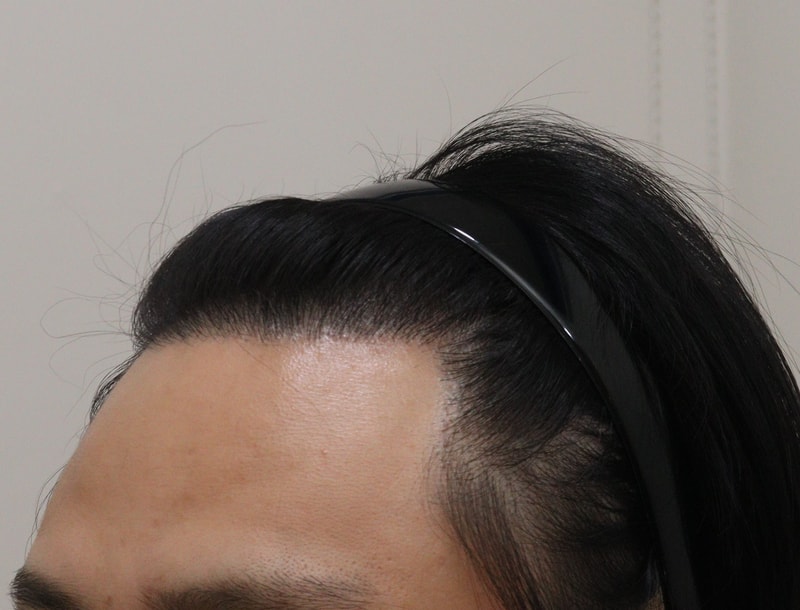 4. 수술후_1년_2.JPG