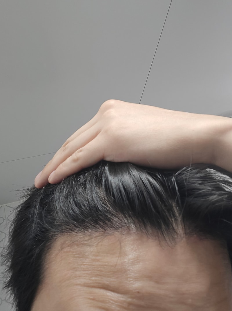 4. 수술후_6개월_셀카_1.jpg