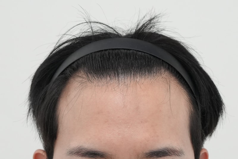수술전.jpg