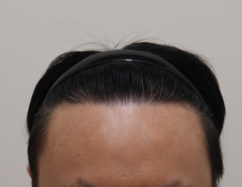 5. 수술후_1년_1.JPG
