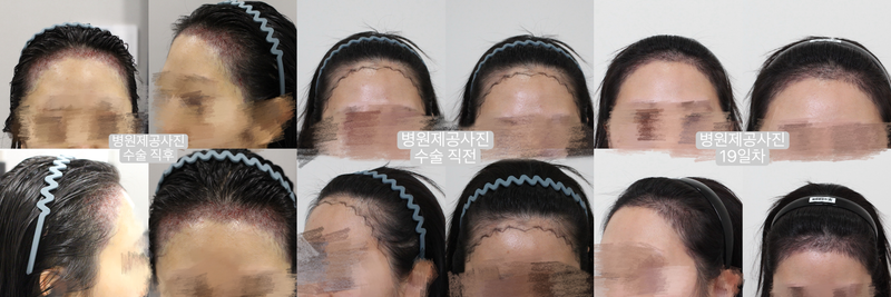 모프로의원 여자 비절개 2700모 후기