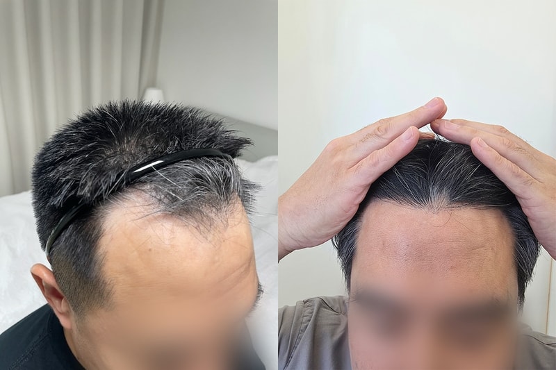 모바름미작 3300모 비절개 1년 됐습니다!