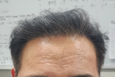 4. 수술후_1년_셀카_1.png