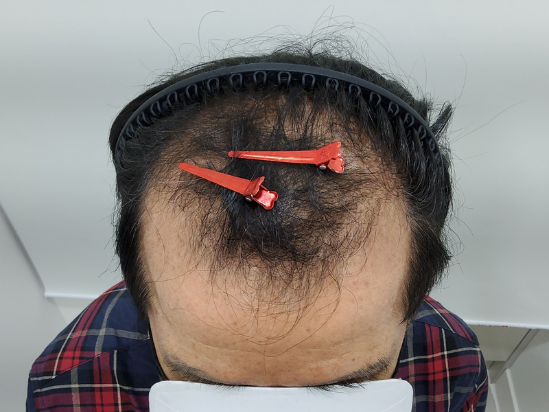 수술전2.png